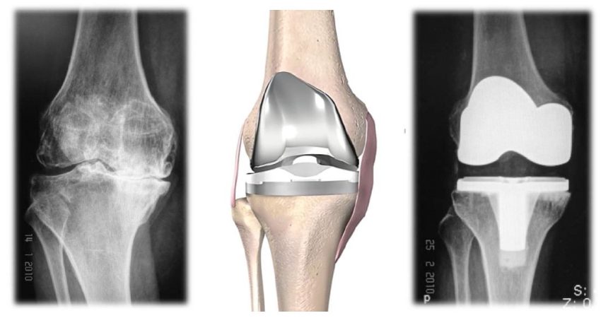 การผ่าตัดเปลี่ยนข้อเข่าเทียมในผู้ป่วยโรคข้อเข่าเสื่อม